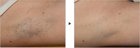 医療レーザー脱毛　脇　症例写真 Laser Hair Removal Underarm　Clinical Photos