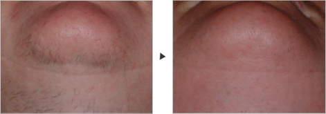 医療レーザー脱毛　あご下　症例写真　Laser Hair Removal Under the chin Clinical Photos