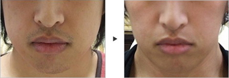 Jaw Reduction with BOTOX