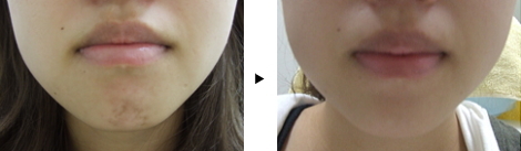 Wrinkle Treatment -Around the mouth – The Pebbly Chin