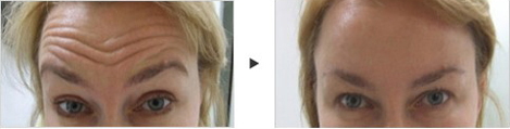 Reverse the Signs of Aging with BOTOX