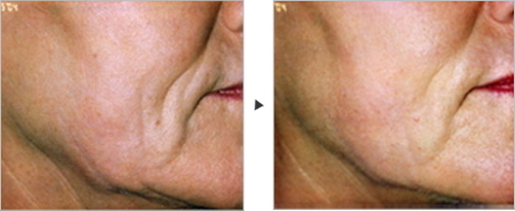 たるみ・しわ・しみ治療　Sagging /Wrinkle Treatment